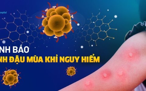 Bệnh Đậu mùa khỉ là gì?